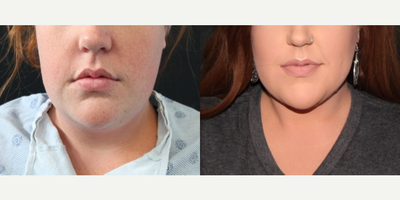 Liposuction before and after photo