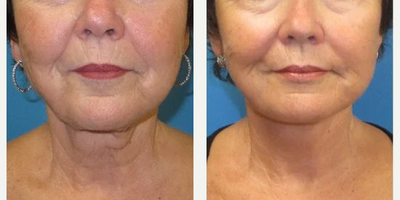 Neck Lift before and after photo