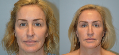 Eyelid Surgery before and after photo