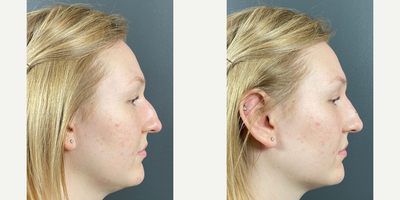 Nonsurgical Nose Job before and after photo