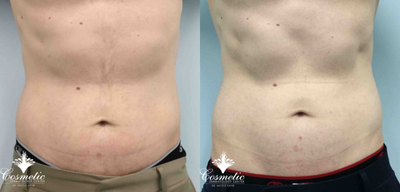 Emsculpt before and after photo