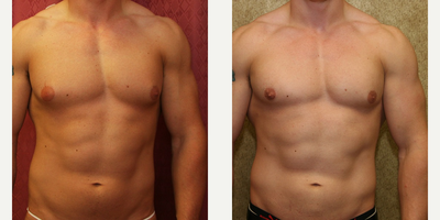 Gynecomastia Surgery before and after photo