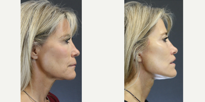 Lip Lift before and after photo