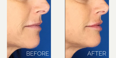 Restylane before and after photo