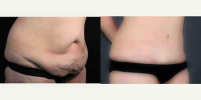 Tummy Tuck before and after photo
