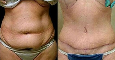 Tummy Tuck before and after photo