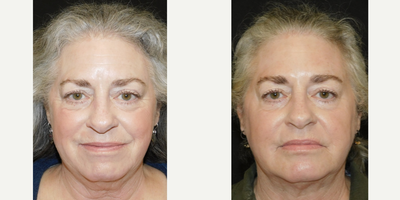 CoolSculpting before and after photo