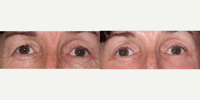 Eyelid Surgery before and after photo