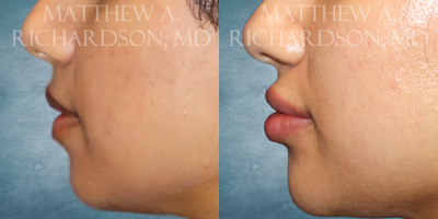 Lip Fillers before and after photo