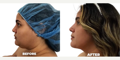 Skin Tightening before and after photo
