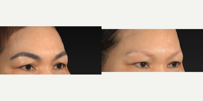 Tattoo Removal before and after photo