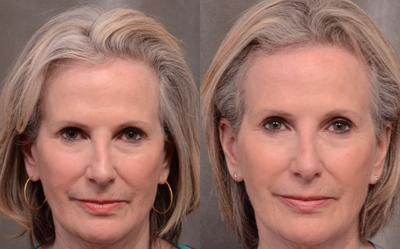 Botox before and after photo