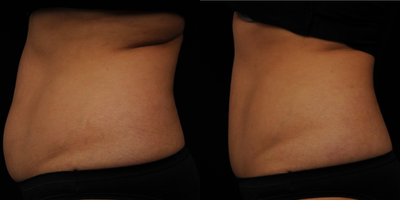 CoolSculpting before and after photo