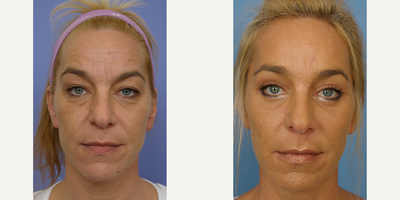 Dermal Fillers before and after photo