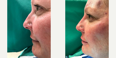 Dermal Fillers before and after photo