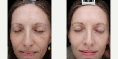 Laser Resurfacing before and after photo