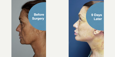 Neck Lift before and after photo