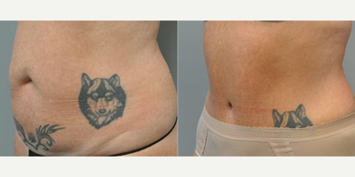 Tummy Tuck before and after photo