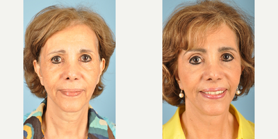 Facelift before and after photo