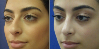 Rhinoplasty before and after photo