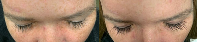Latisse before and after photo