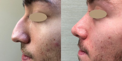 Rhinoplasty before and after photo