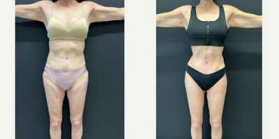 Thigh Lift before and after photo