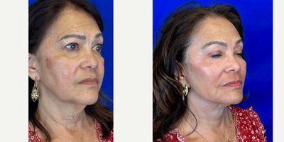 Deep Plane Facelift before and after photo