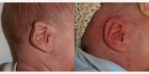 Ear Surgery before and after photo