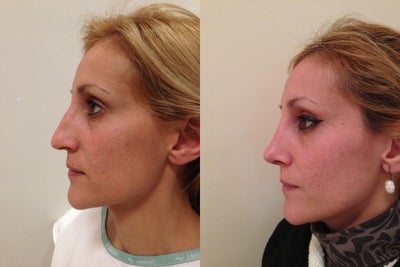 Rhinoplasty before and after photo