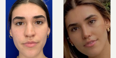 Rhinoplasty before and after photo