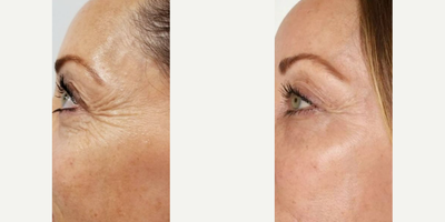 CO2 Laser before and after photo