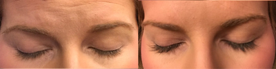 Latisse before and after photo