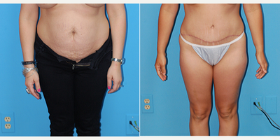 Tummy Tuck before and after photo