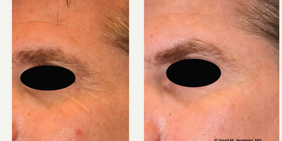 Botox before and after photo