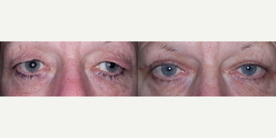 Eyelid Surgery before and after photo