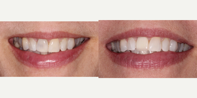 Dental Implants before and after photo
