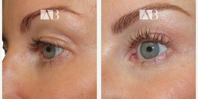 Eyelid Surgery before and after photo