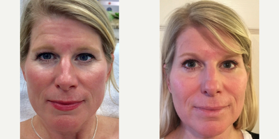 Microneedling before and after photo