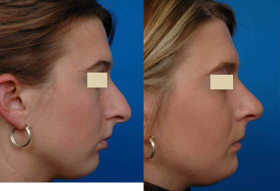 Rhinoplasty before and after photo