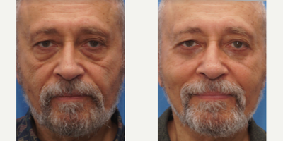 Eyelid Surgery before and after photo