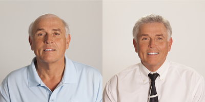 Hair Loss Treatment before and after photo