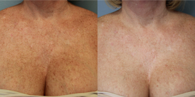 IPL before and after photo
