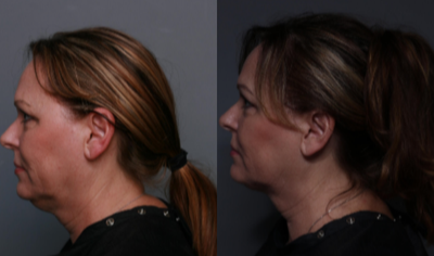 Kybella before and after photo