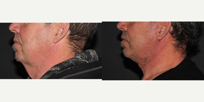 Lower Facelift before and after photo