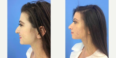 Rhinoplasty before and after photo