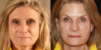 Sculptra before and after photo