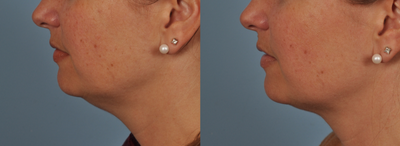 CoolSculpting before and after photo