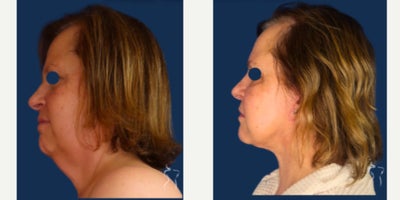 Facelift before and after photo
