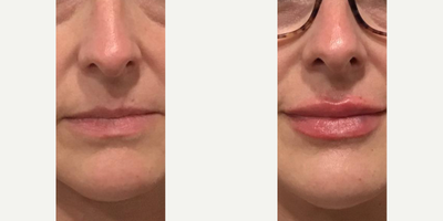Lip Fillers before and after photo